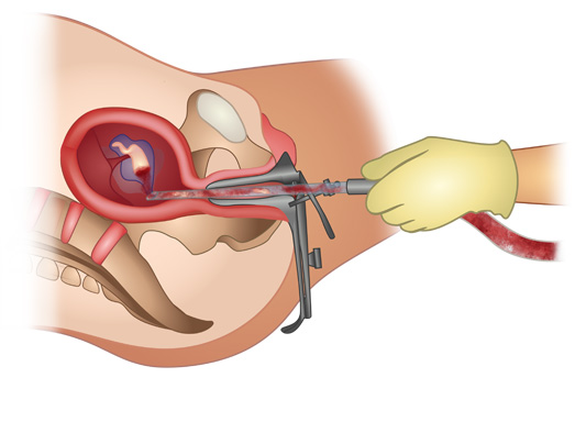 Read more about the article How is surgical Abortion performed in Kenya
