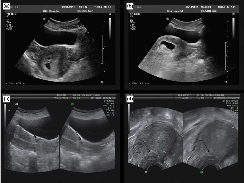 Read more about the article Ultrasound and Abortion